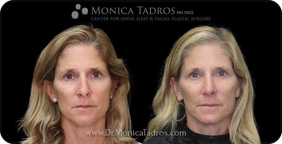revision rhinoplasty experts