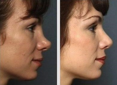 revision rhinoplasty experts