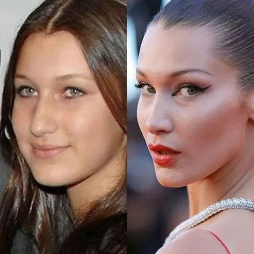 revision rhinoplasty experts