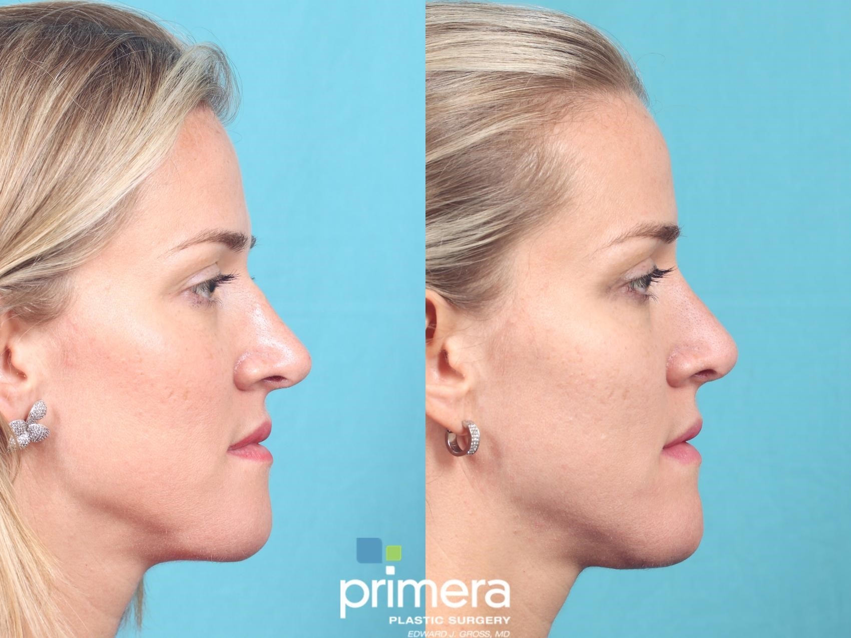 rhinoplasty experts