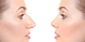 revision rhinoplasty experts